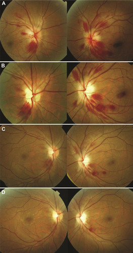 Figure 1 Fundus changes in Wernicke encephalopathy. At initial presentation (A), there is bilateral optic disc edema with peripapillary and scattered retinal hemorrhages. At one week (B) and two weeks (C) following thiamine supplementation, there is significant interval improvement. At three weeks (D) following treatment, there is complete resolution of the optic disc edema and retinal hemorrhages except one residual hemorrhage along the inferotemporal arcade of the left eye. Both optic discs became pale with final best-corrected visual acuity of 20/600 in each eye. Reprinted from J Formos Med Assoc, 112(3), Yeh WY, Lian LM, Chang A, Cheng CK. Thiamine-deficient optic neuropathy associated with Wernicke’s encephalopathy in patients with chronic diarrhea, 165–170, Copyright (2013), with permission from Elsevier.Citation36
