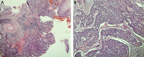 Figure 1 Endoscopy biopsy (A) suggested esophageal squamous cell carcinoma; postoperative pathology (B) demonstrated moderately differentiated esophageal squamous cell carcinoma invading the full thickness of the esophageal wall.