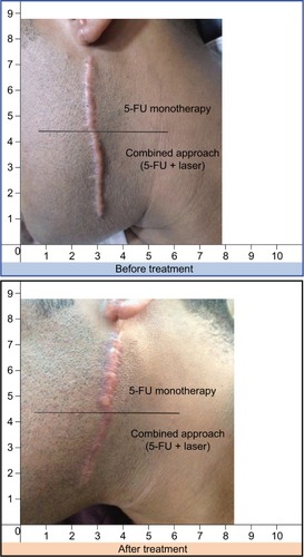 Figure 2 This male patient presented with a post-traumatic scar.