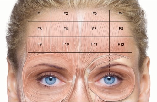 Figure 1 Injection points for the treatment of horizontal forehead lines.