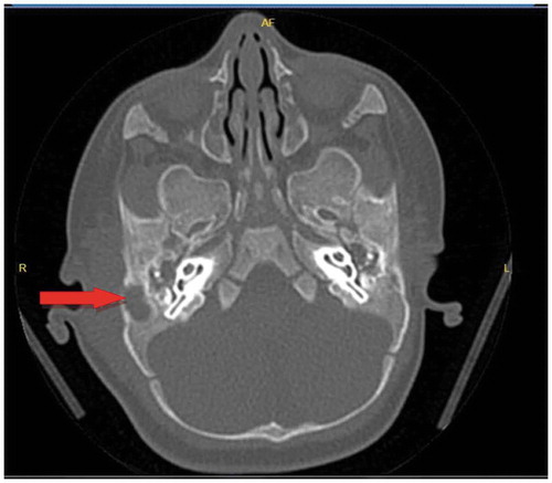 Figure 1. Thickening of the skin in the pre-post auricular region and with arrow bilateral otomastoiditis and destruction of mastoid bone was detected on the right side is seen