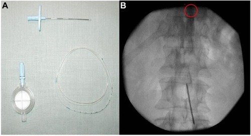 Figure 1 Extra procedural (A) and intraprocedural (B) features of epidural catheter (the tip circled in red).