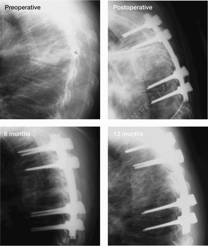 Figure 5. Preoperatively, with evidence of kyphosis. Postoperatively during hospitalization, at 6 months, and B at 12 months