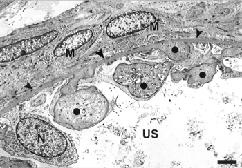 FIG. 11 TEM showing several immature parietal podocytes. Note that extracellular material is surrounded by foot processes (circle). Nucleus of parietal podocyte (N). Basement membrane (arrowheads). Myofibroblast-like cells (M) Urinary space (US). Bar = 2 μm.