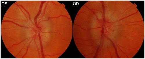 Figure 1 Optic discs appearance at presentation before treatment commenced, November 2009.