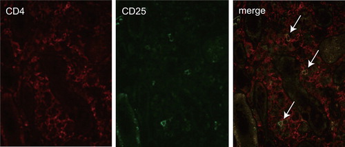 Figure 5. Double immunostaining of CD4 and CD25 in tubulointerstitial lesion. Mononuclear cells positive for CD4 (red) or CD25 (green) are detected. The merge image showed a few cells doubly positive for CD4 and CD25 in an area of interstitial cell infiltration lesion (arrows).