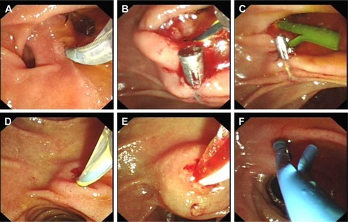 Figure 1 Endoscopic images showing treatment of pancreatic duct stricture and APBJ.Notes: The major papilla was located in the middle of two diverticula (A). Precut of major duodenal papilla was smoothly operated (B). A 10Fr plastic stent was put into CBD to drain bile (C). Cannulation was made in minor duodenal papilla (D). Water balloon dilation was performed to make room for stent placement (E). An 8.5Fr plastic stent was introduced to support dilated pancreatic duct (F).Abbreviations: APBJ, anomalous pancreaticobiliary junction; CBD, common bile duct.