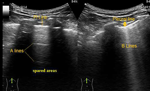Figure 3 B-lines with patchy distribution and spared areas. Left: Speared area with A-pattern; smooth pleural line and A-lines. Right: B-pattern; irregular pleural line and multiple spaced B-lines (poor lung aeration).