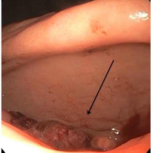 Figure 1 Upper endoscopy demonstrated an ulcerated lesion with an overlying blood clot in the pre-pyloric antrum (arrow).