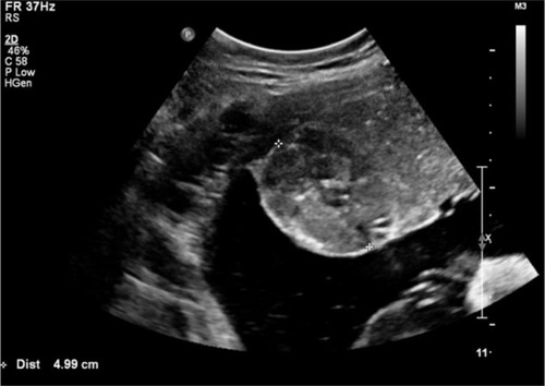 Figure 1 A gray-scale ultrasound image shows a well-defined circumscribed ovoid heteroechogenic placental mass with a 4.99 cm diameter.