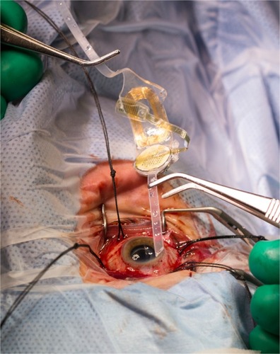 Figure 1 An intraoperative photo shows the internal components of the Argus II device including the coil, the electrode array, and the band which is positioned around the eye.