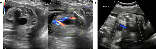 Figure 2 (A) Images of umbilical arteries in twin B at 14+2 weeks. (B) Images of umbilical arteries in twin B at 35+6 weeks.