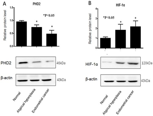 Figure 2 Western blot analysis of PHD2 and HIF-1α protein expression in normal endometrium, atypical endometrial hyperplasia, and endometrial cancer. (A) PHD2 expression was reduced in endometrial cancer compared with normal endometrium (p<0.05, chi-square test). (B) HIF-1α expression was elevated in endometrial cancer compared with normal endometrium (p<0.05, chi-square test). Each protein sample analysis was repeated in triplicate.