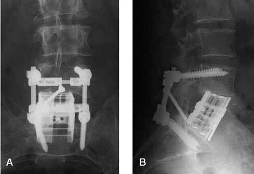 Figure 3. Anteroposterior (A) and lateral (B) radiographs showing circular reconstruction after L5 total spondylectomy.