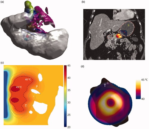 Figure 10. (a) 3D patient specific model and biothermal simulation for endoluminal hyperthermia treatment of a large pancreatic body tumor and surrounding anatomy (model 1): (a) deployed ultrasound applicator (A) (geometry I: two 1 cm OD × 1 cm long transducers, 3.4 MHz, 6 cm balloon aperture) is positioned in the stomach (S) adjacent to lumen wall, and energy directed toward the pancreatic tumor, (b) applicator positioning in the stomach and steady-state temperature distribution overlayed on the planning CT image, (c) detailed temperature distributions with labeled 40 and 43 °C contours across a central axial plane, with both tumor (T) and pancreas (P) delineated; (d) temperature distribution across a transverse plane at 10 mm depth from the applicator surface, with an overlay of the projected tumor boundary; D: duodenum; SMA: superior mesenteric artery; SMV: superior mesenteric vein; SV: splenic vein.