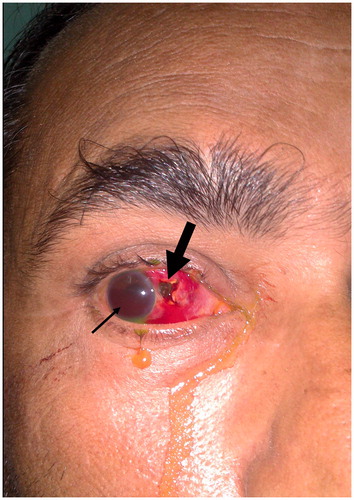 Figure 1. Bold arrow shows uveal tissue prolapse at the point of foreign body entry nasally, 1 mm from the nasal limbus. The entry wound is stellate-shaped. Almost half the anterior chamber is filled with hyphema (thin arrow).
