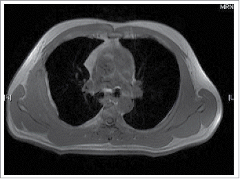 Figure 2. MRI demonstrates thickened soft tissue lesion four months after surgery.
