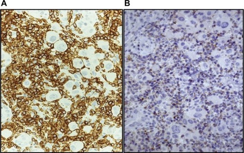 Figure 3 Immunohistochemical characterization of the inflammatory infiltrate surrounding tumor cells at 1 month (A) CD8 and (B) Granzyme-B.