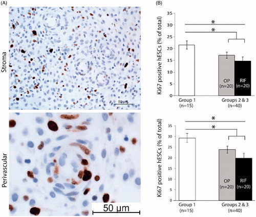 Figure 2. Ki-67 expression in the late-luteal phase. (A) Ki67 staining was detectable throughout the stroma and the perivascular space. (B) Ki-67 staining was not significantly different between women from groups 2 and 3 (stroma, upper graph; perivascular space, bottom graph), while more expression of KI-67 was seen in women from group 1 compared to women from group 3. All women that were not pregnant combined (groups 2 and 3), had lower expression levels of Ki67 compared to women that were pregnant (group 1). *p<.05 (one-way ANOVA, Tukey’s post hoc test). OP: ongoing pregnancy; RIF: repeated implantation failure.