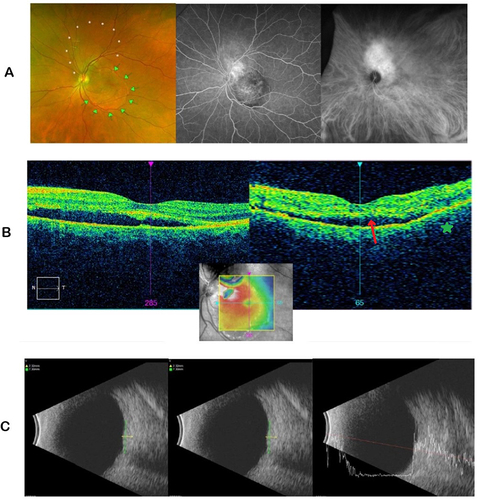 Figure 1 Ancillary testing of the left eye on the patient’s initial presentation, revealing a hemangioma superior to the disc with secondary subretinal fluid in the macula. These were visualized with (A) fundus photos, wide-field fluorescein angiography and indocyanine green angiography, respectively; (B) optical coherence tomography over the macula showing foveal detachment (-->) and choroidal elevation from hemangioma (*); (C) B-scan ultrasonography and A-scan ultrasonography.