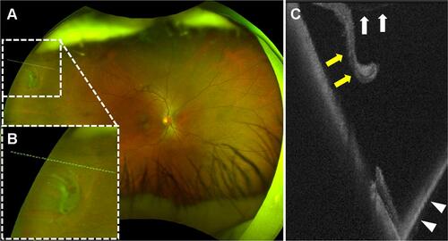 Figure 1 A multimodal imaging of a 54-year-old male with a peripheral retinal tear in the right eye. (A) An ultra-widefield fundus photograph. A retinal tear is observed in the far-peripheral area (white-dotted square). (B) A magnified image of the yellow-dotted square on (A). (C) An ultra-widefield swept-source optical coherence tomography (OCT) image of the yellow-dotted line (A and B). A vitreoretinal traction (white arrows) is observed and a retinal flap is detached from the retina (yellow arrows). Inverted OCT image is also observed (white arrowheads).