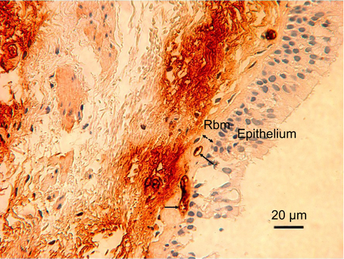 Figure S2 TGF-β-stained vessels in the Rbm are pointed out with arrows. The generalized dark immunostaining in the lamina propria, which is situated beneath the Rbm, impedes vessel identification. The width of the Rbm is shown by a two-headed arrow. Magnification ×400.Abbreviation: Rbm, reticular basement membrane.