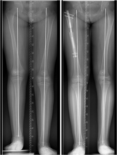 Figure 2 11-year-old girl with cerebral paresis and hemiplegia on her left side. Initial leg length discrepancy was 3 cm, where the hemiplegic side was the longer extremity. She had serious gait problems and gait analysis with shoe augmentation of 4 cm on the right side showed significant improvement of gait parameters. The girl was lengthened 4 cm in her right femur, overcorrecting her by 1 cm, which was advantageous with respect to her left-sided hemiplegia and future growth. Long standing radiographs demonstrate that no shift of MA axis was observed.