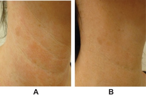 Figure 3 Representative images of neck (A) before treatment and (B) 1 month after 1.0-mL injection of VYC-12L. Images courtesy of Patricia Ogilvie, MD.