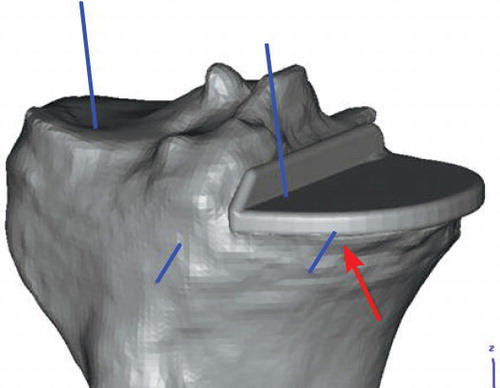 Figure 6. Preoperative planning shows that the medial anterior pin (blue line marked and red arrow) cannot be drilled into bone in a stable way.