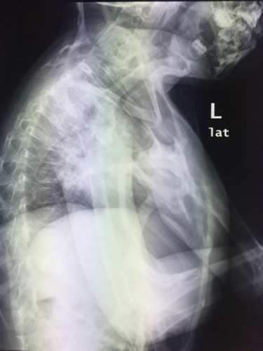 Figure 1: Lateral chest radiograph showing soft tissue ossification and ankylosis of cervical spine and upper limb joints. Ossified sternocleidomastoid muscles can also be seen.