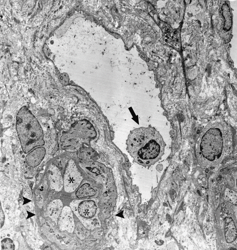 Figure 3. An MN cell in PCs (arrow), postcapillary venule-like transformation (limited by arrowheads), and hypertrophic endothelial cells (*) (Uranyl acetate, lead citrate 1670X).