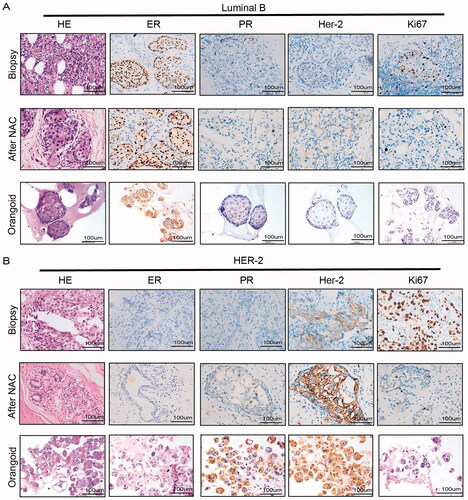 Figure 3. Histological characterization of BC organoids. (A,B) Immunohistochemical comparison of tissues of luminal B and Her2+ breast cancer patients after neoadjuvant chemotherapy and organoids of biopsy specimens before neoadjuvant chemotherapy. Tissues generally present tumour epithelium surrounded by mesenchymal and inflammatory cells, while organoids are exclusively epithelial with tumour cell organization being remarkably well conserved (HE). ER, PR, HER2 status and proliferation index of original BCs are similarly well retained in the derived organoid lines. Scale bar, 100 mm.