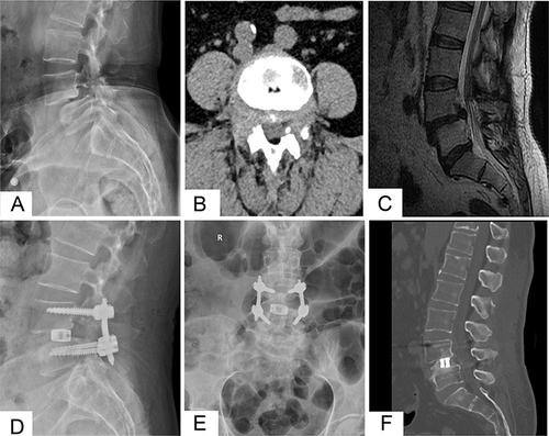 Figure 4 Perioperative imaging examinations in case 1. (A) Preoperative lateral DR revealing the 4th lumbar isthmic spondylolisthesis; (B) preoperative axial CT showing lumbar spinal stenosis; (C) preoperative sagittal MRI showing lumbar spondylolisthesis with stenosis at L4-5 level; (D) postoperative lateral DR after BE-TLIF showing a good reduction in isthmic spondylolisthesis; (E) postoperative posteroanterior DR showing good pedicle screws fixation and a cage implanted transversely; (F) sagittal CT image revealing lumbar interbody fusion with a cage and autologous and allograft bone.