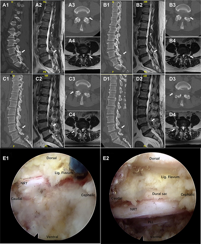 Figure 1 Illustrative case of a 49-year-old woman with lumbar spinal stenosis (LSS), who underwent initial surgery on the left side and reoperation on the right side. Initial preoperative sagittal computed tomography (CT) (A1), sagittal magnetic resonance imaging (MRI) (A2), axial CT (A3) and axial MRI (A4). Initial postoperative sagittal CT (B1), sagittal MRI (B2), axial CT (B3) and axial MRI (B4). The second postoperative sagittal CT (C1), sagittal MRI (C2), axial CT (C3) and axial MRI (C4). The second postoperative sagittal CT (D1), sagittal MRI (D2), axial CT (D3) and axial MRI (D4). Endoscopy showed that the nerve roots and dura were relatively smooth during the reoperation, without obvious scarring (E1) and decompression completion (E2).