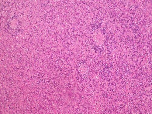 Figure 3 Typical pathological image of the hyaline-vascular (HV) subtype. The picture shows a patient with UCD who underwent lymph node biopsy and was diagnosed as HV subtype of CD by H&E staining.