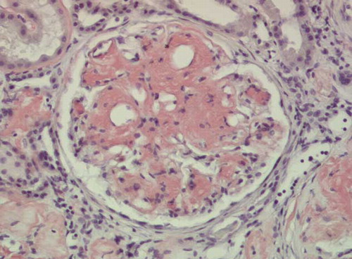 Figure 1.  Glomerular amyloid deposition in mesangiocapillary pattern (Congo red stain ×10).