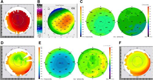 Figure 3 (A and B) Case 3. Pre-op Topography and Pentacam pachymetry. Note the lateralized thinnest point of cornea relative to the apex, and the pre-operative astigmatism. (C) Case 3. Pre-Op OCT Pachymetry and ETM. (D) Case 3. 5 month post-op. Note the elliptical, irregular ablation pattern. (E) Case 3. 5 Month Pachymetry and ETM. Note the irregular thickening of the epithelium of the elliptical. (F) Case 3. 3 months post enhancement. Enhancement done via topographic-guided ablation. Notice the smooth, round, more regular ablation pattern.