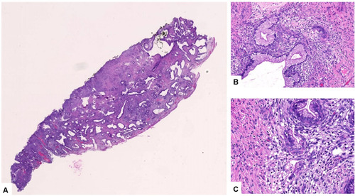 Figure 2 Histopathology of LEEP specimen. HE staining of minimal deviation adenocarcinoma and loss of lobular structure with invasive growth. (A) Tumorous glands are diffusely distributed and infiltrate extensively, and cancerous involvement can be seen on the cervical intimal margin (upper border). (B) The glands are well differentiated, similar to the gastric glands. (C) Fibrous reaction and chronic inflammatory cell infiltration can be seen around the gland.