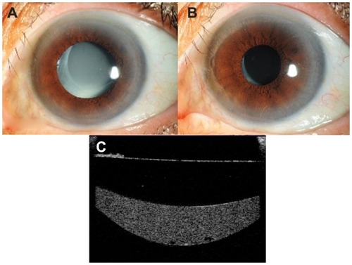 Figure 1 (A) Slit-lamp photograph showing characteristic milky fluid within the capsular bag in a patient with late capsular bag distension syndrome. (B) Slit-lamp photograph showing resolution of the milky fluid post-YAG capsulotomy. (C) Anterior segment optical coherence tomography showing the hyperintense signal within the capsular bag.
