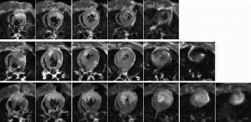 Figure 1. Gadophrin III enhanced multislice short axis views after 25 min coronary occlusion and 3 h reperfusion: The control group (top row) shows similar infarction size as nicorandil treated animals with aortic banding (middle row). The size of infarction was larger in untreated animals subjected to aortic banding (bottom row).