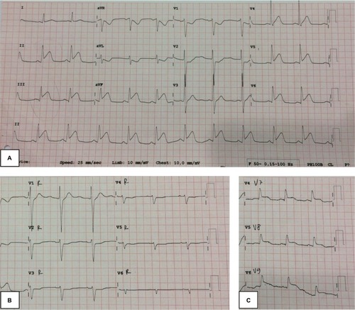 Figure 1 Electrocardiogram readings at emergency department.