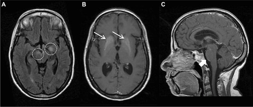 Figure 1 MRI findings at onset of neurological disturbances.