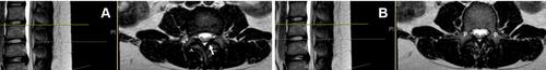 Figure 2 At the lower disc level (A), the central canal is bordered anteriorly by the posterior annulus and posterolaterally by the superior articulating process (SAP) (double arrow heads). Posteriorly, the central canal is bordered by the ligamentum flavum (arrow). The lateral border of the central canal is the superior and inferior articulating process (double and single arrowheads, respectively) which creates the facet joint. (B) demonstrates pedicular architecture at the superior endplate (P) and lack of neural foramen.