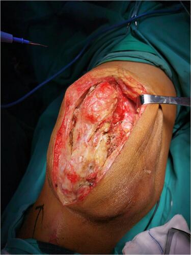 Figure 3 Intra-operative (anterior approach) photograph showing the nature of the synovial osteochondromatosis.