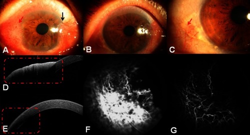 Figure 4 Anterior segment images of Case 3 (right eye). (A) A large papillomatous tumor involving the temporal cornea, limbus, and conjunctiva (red arrow), with pterygia on the nasal side (black arrow). (B, C) The tumor completely disappeared after treatment, tiny palpebral fissures remained in the primary tumor area (red arrow), and the pterygia was unchanged. (D) AS-OCT demonstrated an abrupt transition between unremarkable and thickened hyper-reflective epithelium. However, in this large lesion, a shadow from the hyper-reflective epithelium sometimes obscured the plane of cleavage (red dots). (E) The neoplasm was completely replaced by a normal epithelium after treatment as shown using AS-OCT (red dots). (F) There were only a few dilated conjunctival vessels with partial leakage found through FA after treatment. (G) Both intratumoral vessels and conjunctival feeding vessels disappeared after treatment, as observed on anterior segment ICGA.Abbreviations: AS-OCT, anterior segment optical coherence tomography; FA, fluorescein angiography; ICGA, conjunctival indocyanine green angiography.