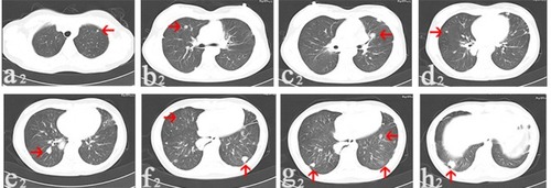 Figure 2 In August 2014, CT images collected after denosumab treatment for 6 months showed multi-lung metastatic nodules (arrows) reduced in size and number.Notes: The nodule reduced to 0.4 cm in diameter (a2); the nodule reduced to 0.6 cm in diameter (b2); the nodule was with lower density than before and reduced to 1.0 cm in diameter (c2); the nodule reduced to 0.4 cm in diameter (d2); the nodule reduced to 1.2 cm in diameter (e2); the nodule on the right side reduced to 1.2 cm in diameter and the one on the left side disappeared (f2); one nodule disappeared and two nodules reduced to 1.0 and 0.8 cm in diameter (g2); the nodule reduced to 1.4 cm in diameter (h2).Abbreviation: CT, computerized tomography.