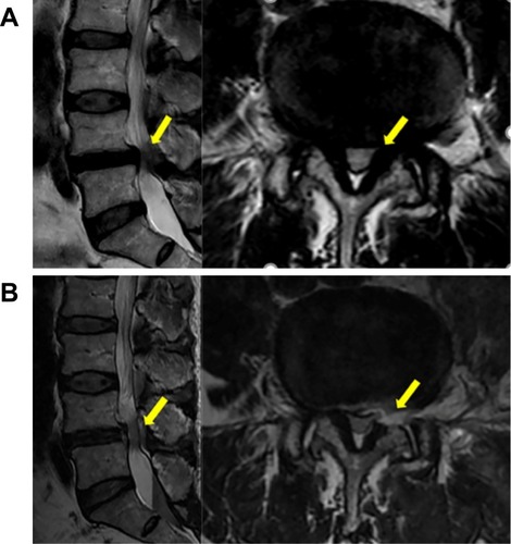 Figure 4 An 81-year-old female patient with lumbar lateral recess stenosis (LRS) who received PELD. (A) Preoperative magnetic resonance images (MRI) showing severe lateral recess stenosis with LRS at the left L4-5 level (yellow arrowhead). (B) Postoperative MRI showing a thorough nerve decompression (yellow arrowhead).