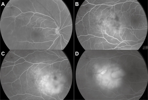 Figure 5 Case 2. Fluorescein angiography sequence. Progressive and heterogeneous hyperfluorescence, with pin points temporal to the mass.