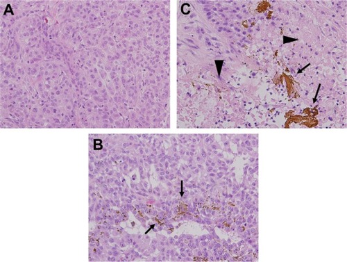 Figure 4 Microscopic appearances of tumor specimens. (A and B) Necrosis was not induced in tumors in group 1 or 2 (hematoxylin and eosin staining, ×200). (C) Ferucarbotran was injected into tumors (arrows) and tumor cells around ferucarbotran in group 3 showed broad necrosis after inductive hyperthermia (arrowheads, hematoxylin and eosin staining, ×200 field).