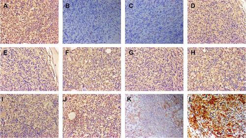 Figure 7 The immunostaining of bone marrow after one course of chemotherapy. (A) (b-FGF;×200), positive; (B) (CD19;×200), negative; (C) (CD117×200), negative; (D) (IL-1β;×200), positive; (E) (IL-2;×200), positive; (F) (IL-6;×200), positive; (G) (IL-10;×200), positive; (H) (PDGF×200), positive; (I) (TGF-β×200), positive; (J) (TNF-α×200), positive; (K) (VEGF×100), positive; (L) reticular fiber staining ×200, MF-1.